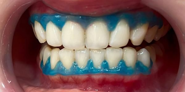 Sesudah bleaching: warna gigi tampak lebih cerah, masih terpasang pelindung gusi berwarna biru.