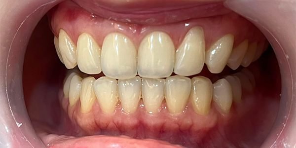 Sebelum bleaching: warna gigi tampak kekuningan.