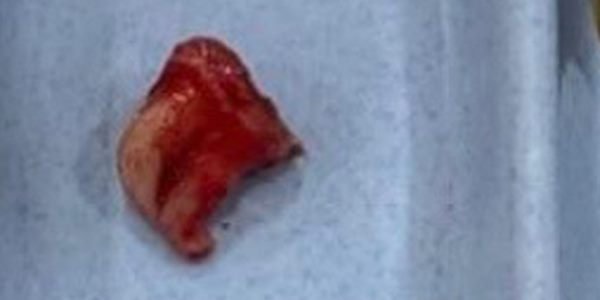 Sesudah odontektomi: gigi bungsu yang telah diangkat.