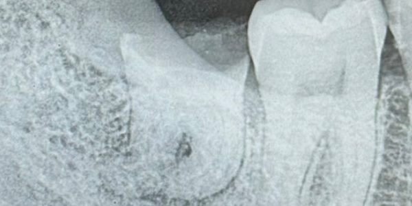 Sebelum odontektomi: foto rontgen memperlihatkan gigi bungsu tumbuh miring dan terpendam.