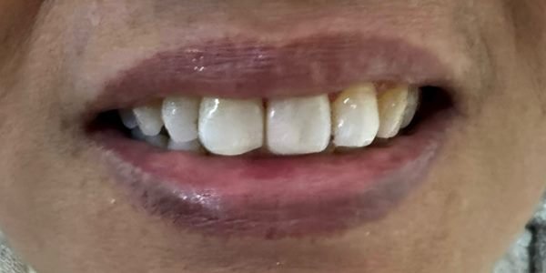 Sesudah penambalan gigi depan: bentuk dan warna gigi kembali rata dan menyatu.